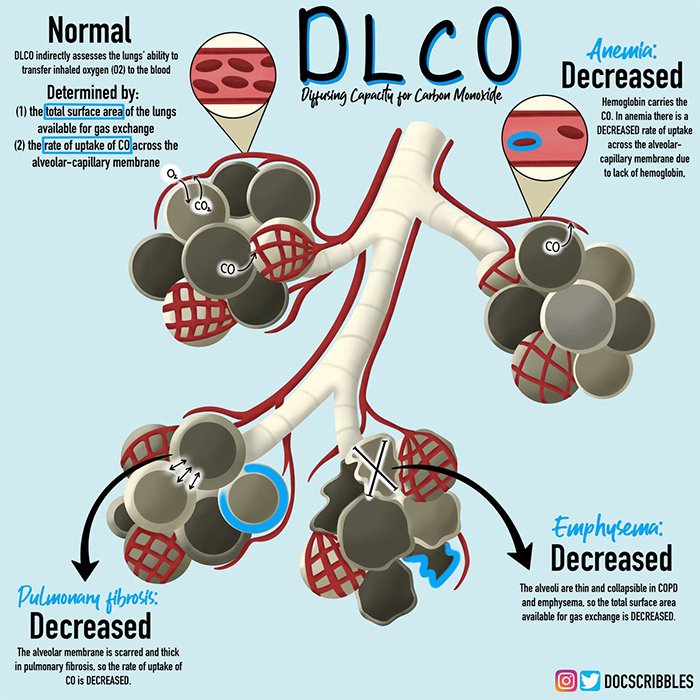 The Association Of Abnormal Pulmonary Vasculature On CT Scan For COVID 